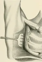 An illustration from Surgery of the lung (1913)