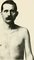 An illustration from Surgery of the lung (1913)