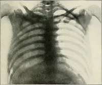 An illustration from Surgery of the lung (1913)