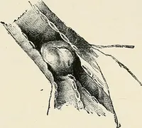 An illustration from Surgery of the lung (1913)