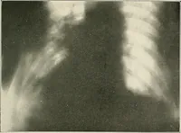 An illustration from Surgery of the lung (1913)