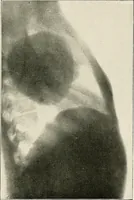 An illustration from Surgery of the lung (1913)