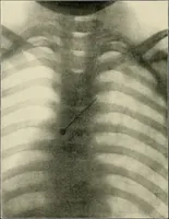 An illustration from Surgery of the lung (1913)