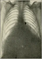 An illustration from Surgery of the lung (1913)