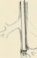 An illustration from Surgery of the lung (1913)