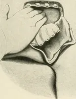 An illustration from Surgery of the lung (1913)