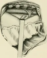 An illustration from Surgery of the lung (1913)