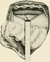 An illustration from Surgery of the lung (1913)