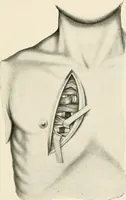 An illustration from Surgery of the lung (1913)