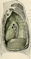 An illustration from Surgery of the lung (1913)