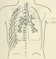 An illustration from Surgery of the lung (1913)