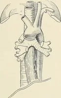 An illustration from Surgery of the lung (1913)