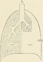 An illustration from Surgery of the lung (1913)