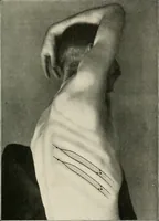 An illustration from Surgery of the lung (1913)