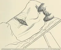 An illustration from Surgery of the lung (1913)