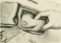 An illustration from Surgery of the lung (1913)