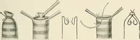 An illustration from Surgery of the lung (1913)