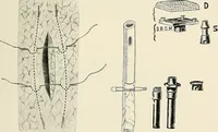 An illustration from Surgery of the lung (1913)