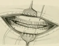 An illustration from Surgery of the lung (1913)