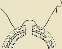 An illustration from Surgery of the lung (1913)