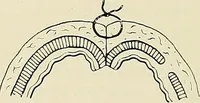 An illustration from Surgery of the lung (1913)