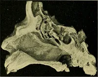 An illustration from A text-book of diseases of the nose and throat (1904)