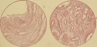 An illustration from A text-book of diseases of the nose and throat (1904)