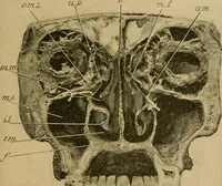 An illustration from A text-book of diseases of the nose and throat (1904)