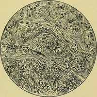 An illustration from A text-book of diseases of the nose and throat (1904)
