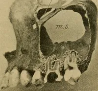 An illustration from A text-book of diseases of the nose and throat (1904)