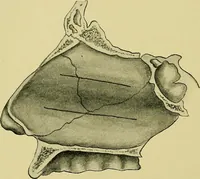 An illustration from A text-book of diseases of the nose and throat (1904)