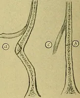 An illustration from A text-book of diseases of the nose and throat (1904)