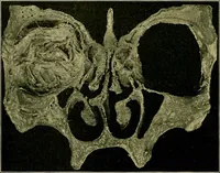 An illustration from A text-book of diseases of the nose and throat (1904)