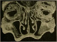 An illustration from A text-book of diseases of the nose and throat (1904)