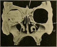 An illustration from A text-book of diseases of the nose and throat (1904)