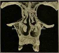 An illustration from A text-book of diseases of the nose and throat (1904)