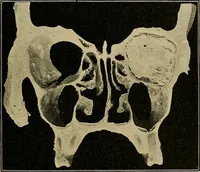 An illustration from A text-book of diseases of the nose and throat (1904)