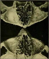 An illustration from A text-book of diseases of the nose and throat (1904)