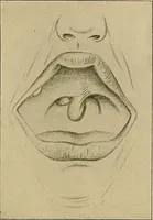 An illustration from A text-book of diseases of the nose and throat (1904)