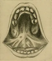 An illustration from A text-book of diseases of the nose and throat (1904)