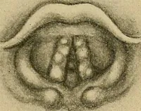 An illustration from A text-book of diseases of the nose and throat (1904)