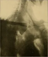 An illustration from A text-book of radiology (1915)