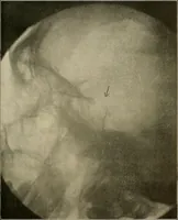 An illustration from A text-book of radiology (1915)