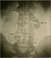 An illustration from A text-book of radiology (1915)