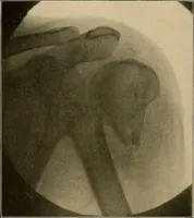 An illustration from A text-book of radiology (1915)