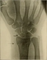 An illustration from A text-book of radiology (1915)