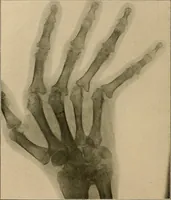 An illustration from A text-book of radiology (1915)