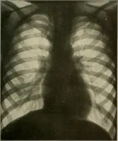 An illustration from A text-book of radiology (1915)
