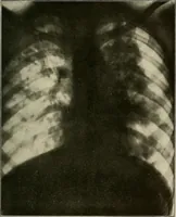 An illustration from A text-book of radiology (1915)