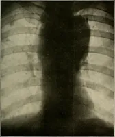 An illustration from A text-book of radiology (1915)